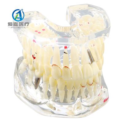 China Hot Sale Anatomical Model For Analysis With Pathological Dental Caries, Impaction And Fracture Of Multifunctional Model for sale