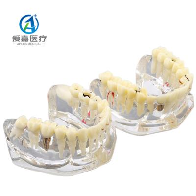 China Original Factory Multifunctional Model 2 Times Dental Education Models Tooth Pathology Clear Model For Study for sale