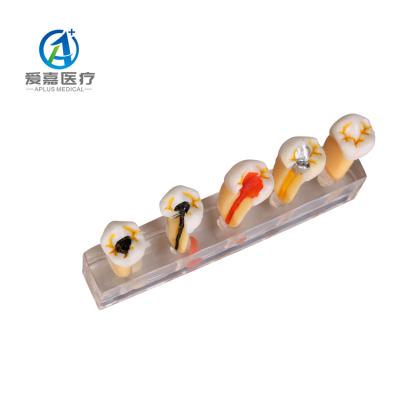 China Affected Human Structures Pathological NEW ORIGINAL For Dental Endodontic Analysis Root Canal Model for sale