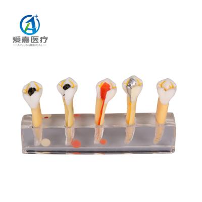 China Affected Human Structures New Design Dental Endodontic Root Canal Treatment Tooth Model With High Quality for sale