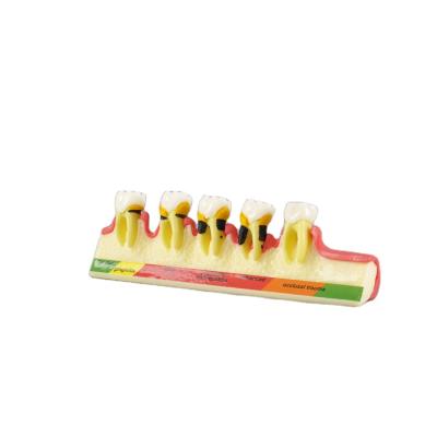 China Clinic and Hospital Hot Sale Human Teeth Dental Dental Models for Patient Teaching Periodontal Model for sale