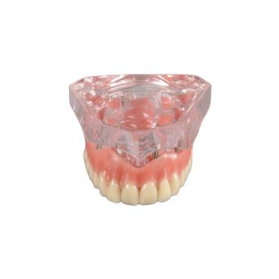 China Clear Display Structure Denture Restoration Model Upper Jaw Dental Implant Education Model 4 Implants for sale