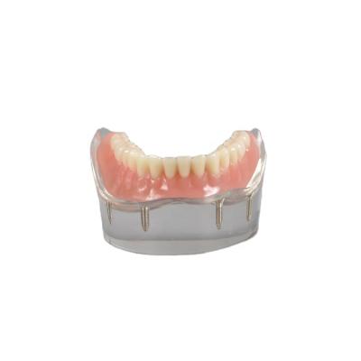 China Clear Display Structure Dental Implant Study Model Mandibular Denture Jaw Model Showing 4 Implants and Abutments for sale