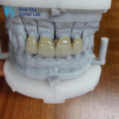 China Durable Zirconia Layered With Porcelain Zirconia Multilayer Crown for sale