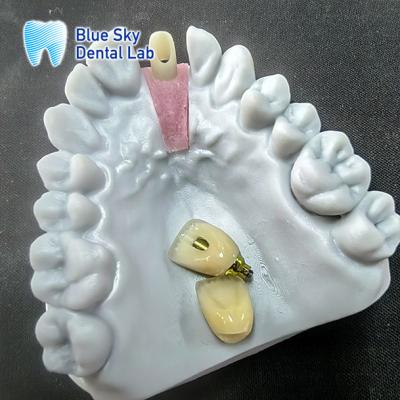 China Precision Milled Zirconia Abutment With Single Implant Crown for sale