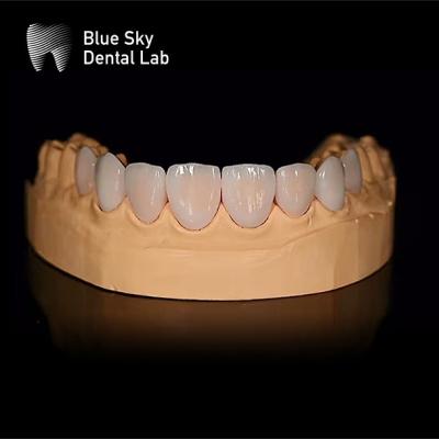 China Lightweight Rectangular Dental Veneer Cases With Passive Fitting Only 0.3mm for sale