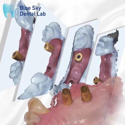 China Scan Body  All In One Dental Healing Capsule Blue Sky Implant System for sale