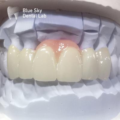 China Layered Zirconia Crowns Pink Porcelain Zirconia Dental Crown For Aesthetic Restorations for sale