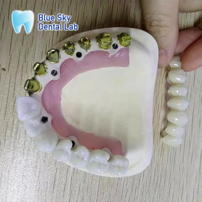 China Silver Gold Pure Titanium Metal Frame Dental Gold Plated Metal Frame Partial for sale