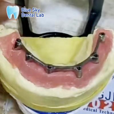 China Titanium Bar Overdenture Removable Implant  With Overdenture for sale