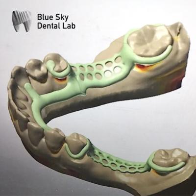 China Removable Partial Denture Metal Framework Partial Denture Framework Design for sale