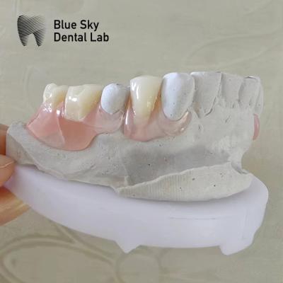 China Natural Smile Dental Valplast Dentures Flexi Valplast Removable Partial Denture for sale