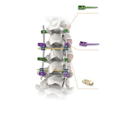 中国 Spinal Spinal Orthopedic Spine Implants Fixation Pedicle Screw Polyaxial System 販売のため