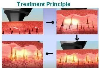 China Permanente menos invasor de la máquina del retiro del pelo del alexandrite del laser en venta